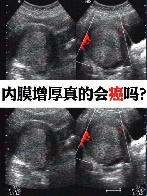 子宫内膜增厚是怎么回事的相关图片